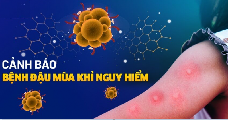 Liên tục ghi nhận các ca bệnh đậu mùa khỉ. Khuyến cáo của Chuyên Gia Bệnh Viện Công Vĩnh !